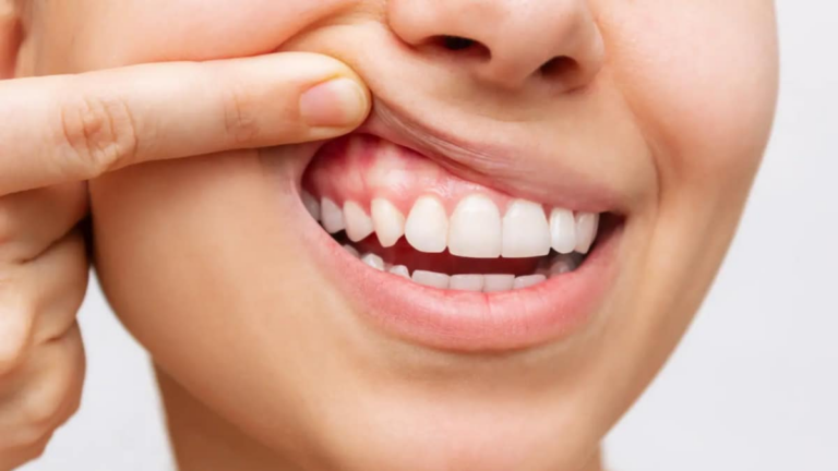 From Mouth To Heart: How Oral Bacteria May Secretly Trigger Heart Attacks | Health and Fitness News